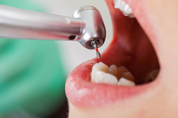 Best Broken or Cracked Tooth Emergency Dentist in Cut Off, LA